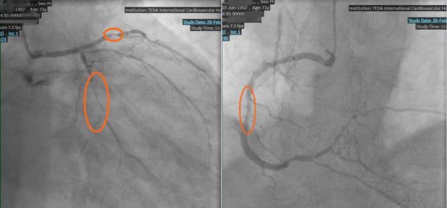 泰心医院完成首例介入式左心室辅助下高危病变支架术一活动就胸闷心脏血管近乎全面堵塞(图1)
